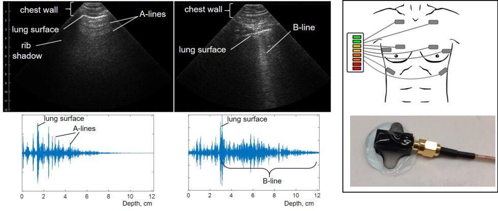Left: Lung ultrasound images with A-lines and B-lines plus corresponding probe signals. Right: Diagram of LUSS for lung monitoring and a prototype element. Adhesive LUSS elements are placed at 10 anatomical sites, with automated software scoring lung fluid on a 4-point scale: none (green), mild (yellow), moderate (orange), severe (red).