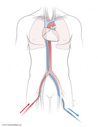 ECMO 1