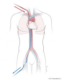 ECMO 2